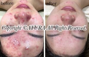 ニキビによる赤みや炎症の肌を、ケア前後で比較した写真。
