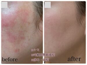 頬にシミが見られる肌の状態。