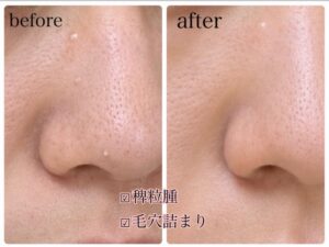 鼻や頬に毛穴詰まりや白いポツポツ（白ニキビ）が見られる肌の状態。