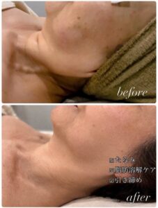 和歌山 若返りサロン 何歳にっても綺麗でいたい。たるみ老け顔…年レ肌に負けない