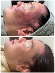 アトピー肌による乾燥や肌荒れに悩んでいた方のスキンケア前後の様子