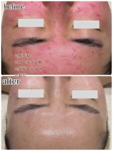 肌荒れや赤みが気になるお客様のスキンケア前後の様子