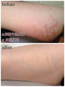 施術後に赤みや熱感などの違和感が現れたお客様の肌状態の記録画像