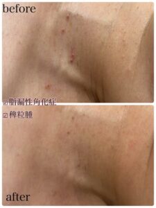 首に脂漏性角化症や小さなイボ（スキンタッグ）が見られる肌の状態。