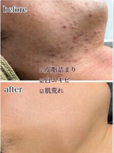 白ニキビが頬やあごに点在している肌の状態。